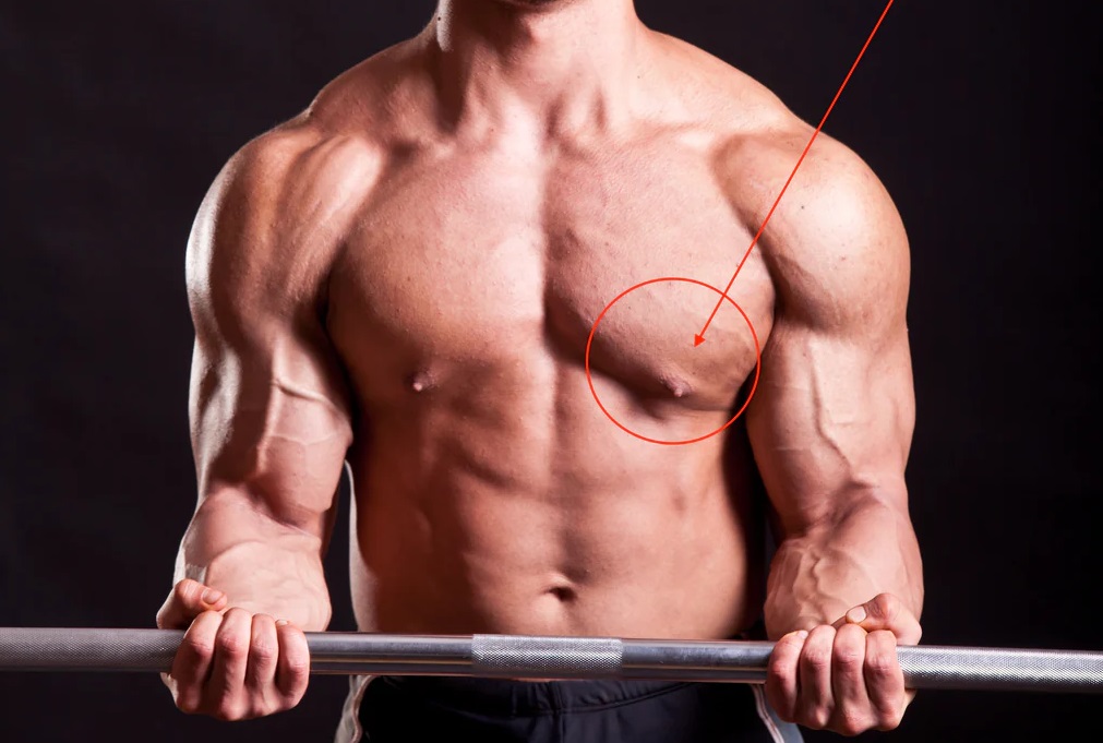 Treatment for gynecomastia: Will Raloxifene be effective?